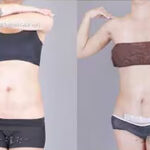 Tummy-Tuck-Liposuction-and-Fat-Grafting-na-yeon02