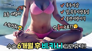 Tummy-Tuck-Liposuction-and-Fat-Grafting-na-yeon05