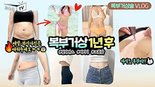 Tummy-Tuck-Liposuction-and-Fat-Grafting-na-yeon06