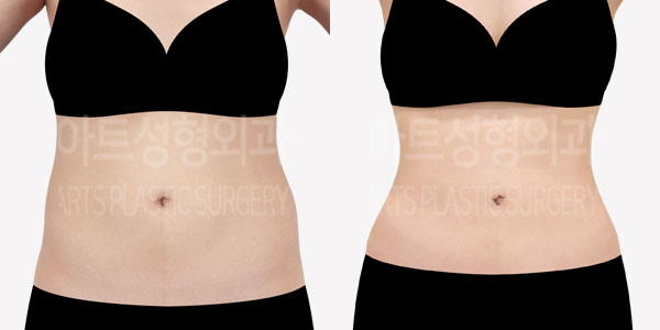 abdominal_liposuction_01_thumbnail