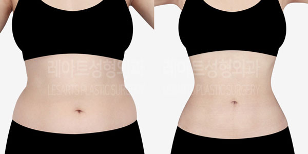 abdominal_liposuction_01_thumbnail_231209