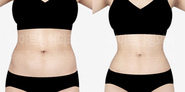 abdominal_liposuction_01_thumbnail_231221