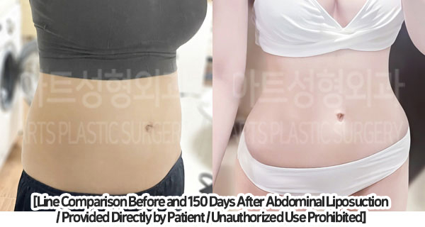 abdominal_liposuction_02_01