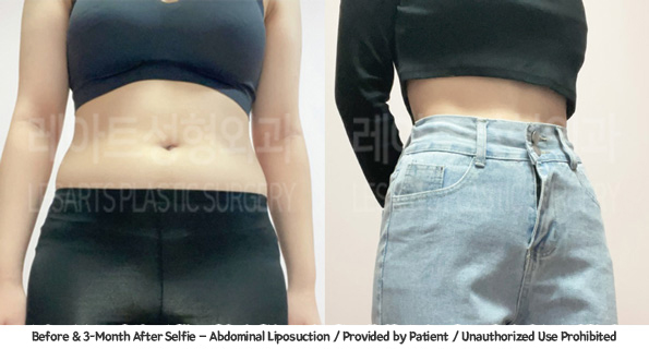 abdominal_liposuction_02_01_231221