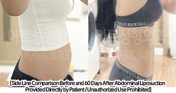 abdominal_liposuction_02_02