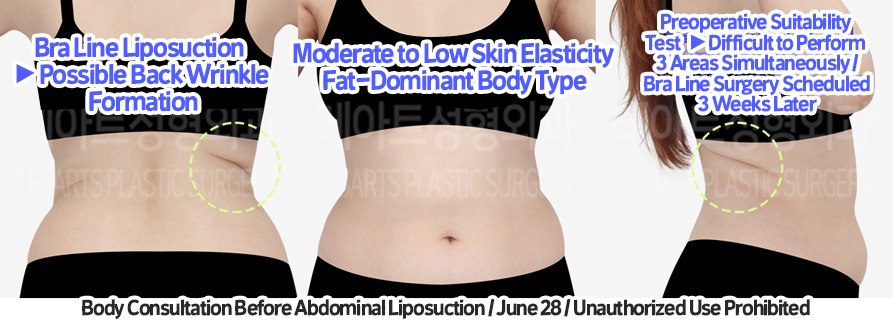 abdominal_liposuction_02_02_231209