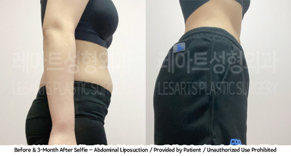 abdominal_liposuction_02_02_231221