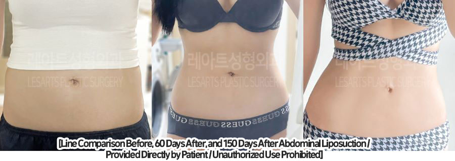 abdominal_liposuction_02_03