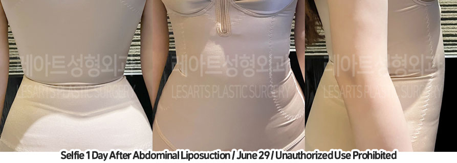 abdominal_liposuction_02_03_231209