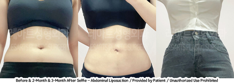 abdominal_liposuction_02_03_231221