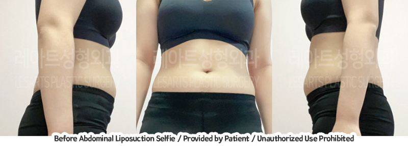 abdominal_liposuction_02_04_231221