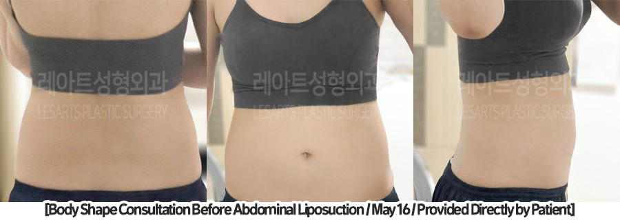 abdominal_liposuction_02_05