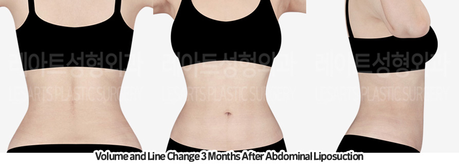 abdominal_liposuction_02_05_231209