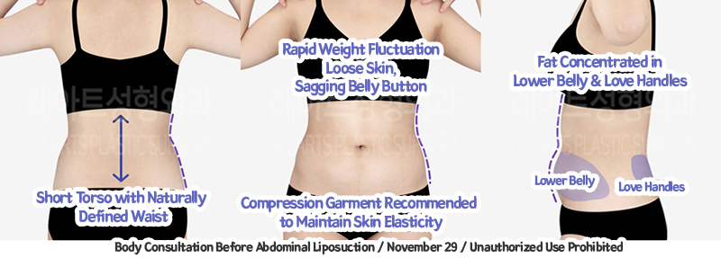 abdominal_liposuction_02_05_231221