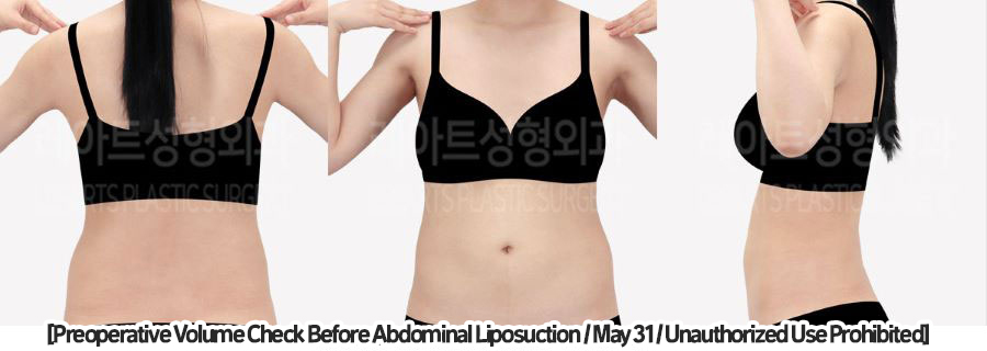 abdominal_liposuction_02_06