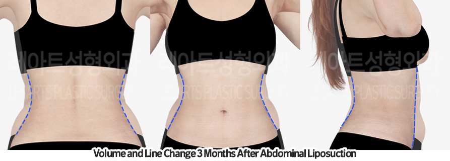 abdominal_liposuction_02_06_231209