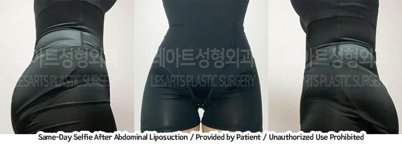 abdominal_liposuction_02_06_231221