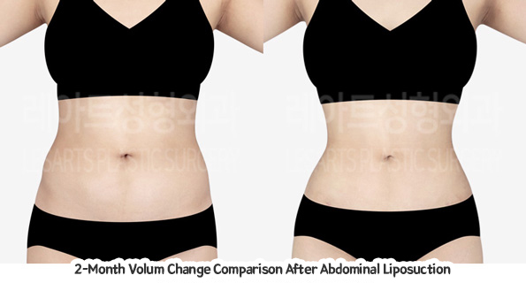 abdominal_liposuction_02_07_231221