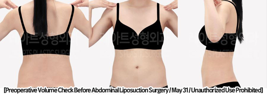 abdominal_liposuction_02_08