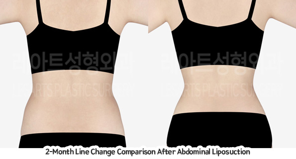 abdominal_liposuction_02_08_231221