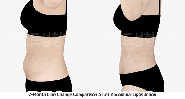 abdominal_liposuction_02_09_231221