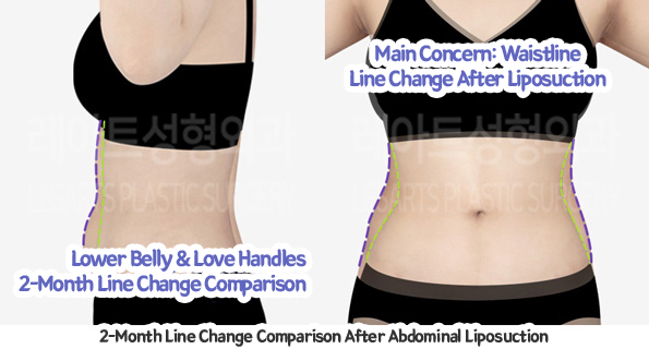 abdominal_liposuction_02_10_231221
