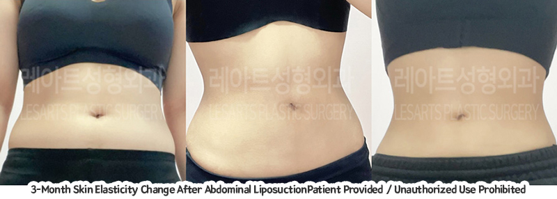 abdominal_liposuction_02_11_231221