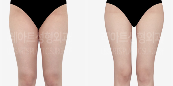 full_body_liposuction_01_thumbnail_231215