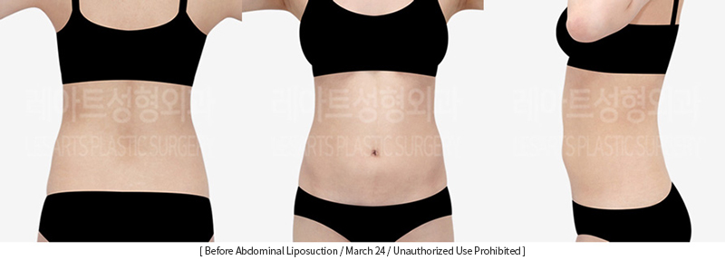 full_body_liposuction_02_01_231215