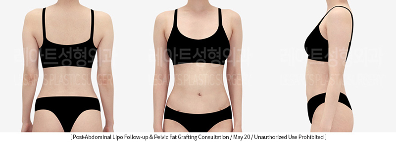 full_body_liposuction_02_02_231215