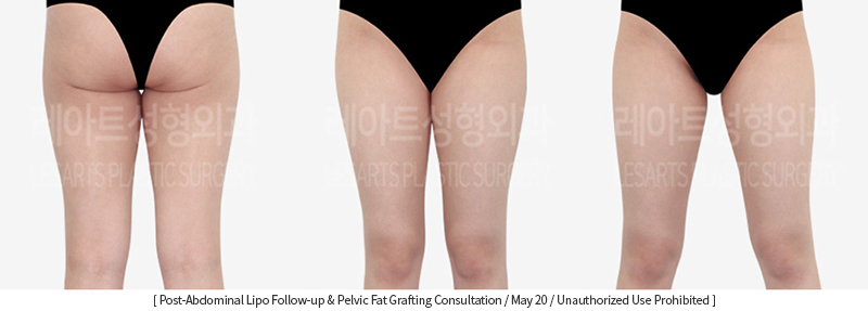 full_body_liposuction_02_03_231215