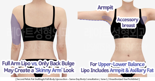 full_body_liposuction_02_04_231215