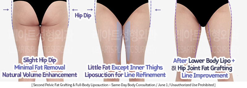 full_body_liposuction_02_05_231215