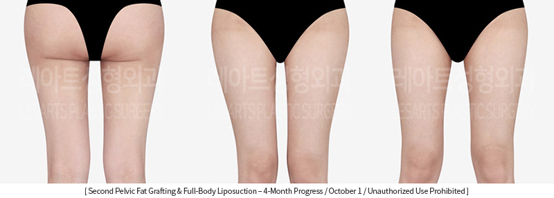 full_body_liposuction_02_07_231215