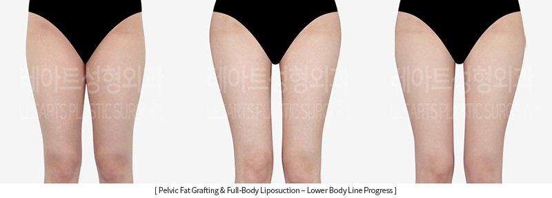 full_body_liposuction_02_08_231215