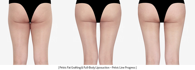 full_body_liposuction_02_09_231215