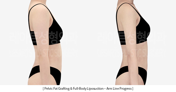 full_body_liposuction_02_10_231215