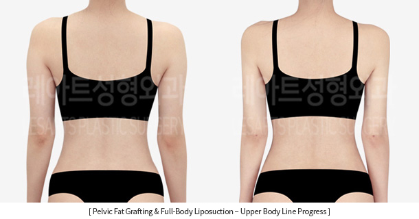 full_body_liposuction_02_11_231215