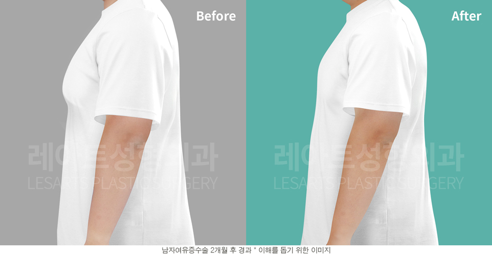 post_17_gynecomastia -after-Medical-photo2