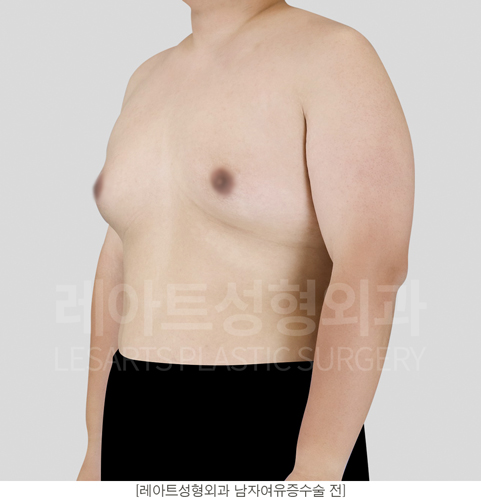 post_17_gynecomastia -before-Medical-photo2
