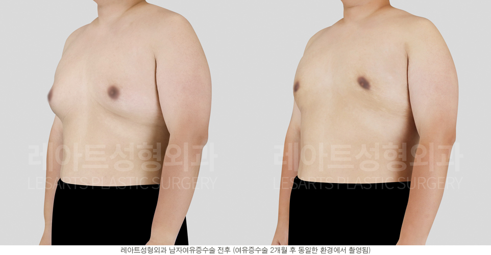 post_17_gynecomastia -before-Medical-photo3