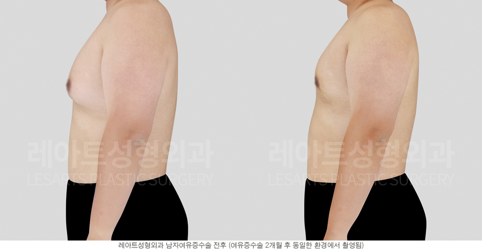 post_17_gynecomastia -before-Medical-photo4