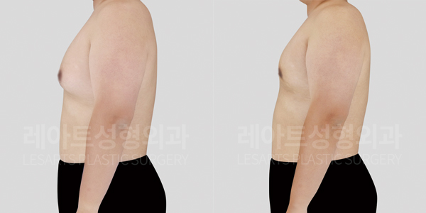 post_17_gynecomastia -before-after_wide-thumbnail