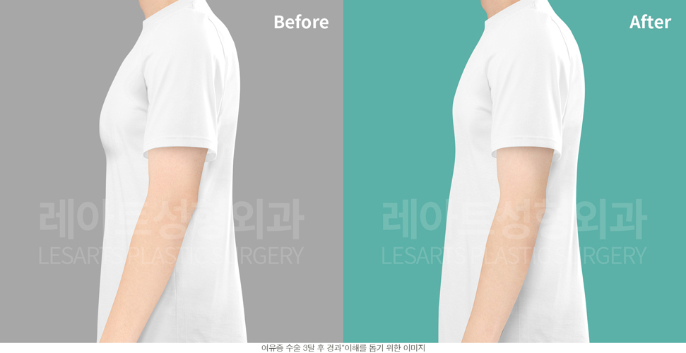 post_18_gynecomastia -after-Medical-photo2
