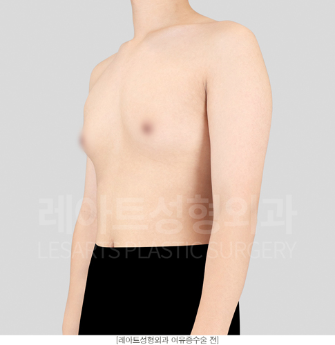 post_18_gynecomastia -before-Medical-photo