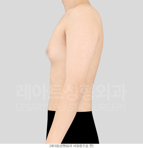 post_18_gynecomastia -before-Medical-photo2