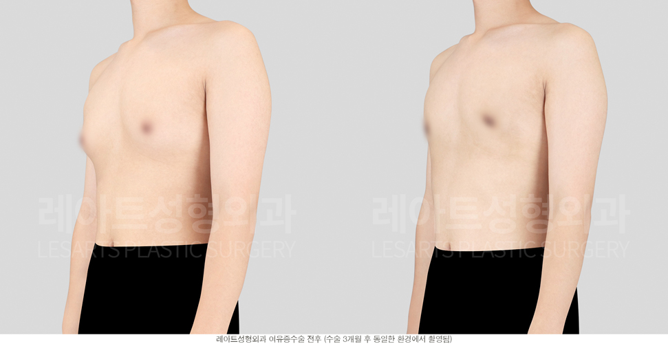 post_18_gynecomastia -before-Medical-photo3