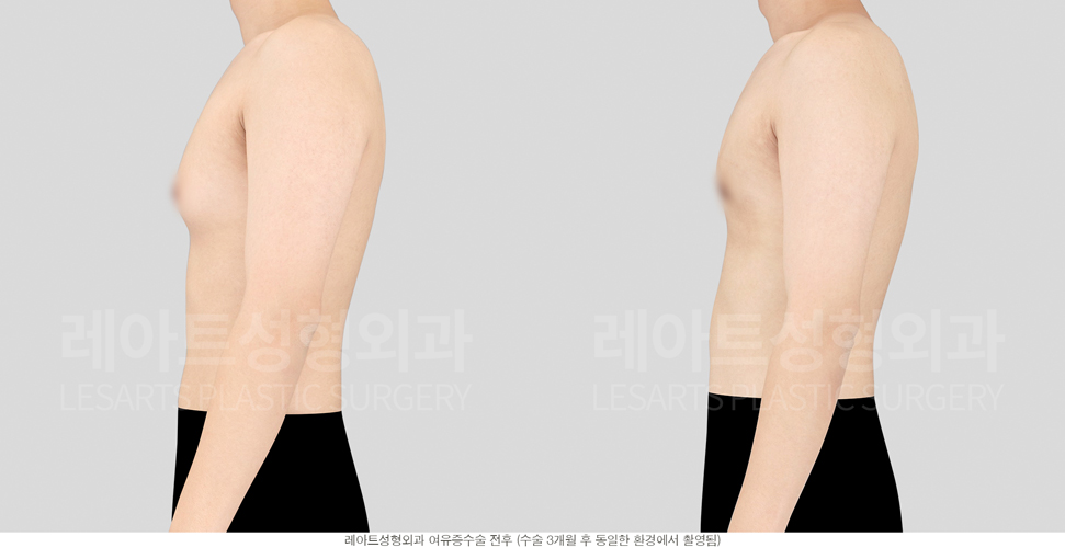post_18_gynecomastia -before-Medical-photo4
