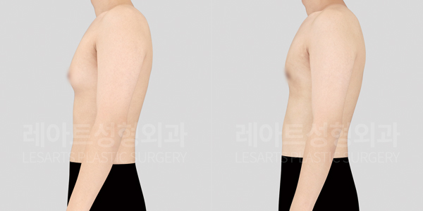 post_18_gynecomastia -before-after_wide-thumbnail