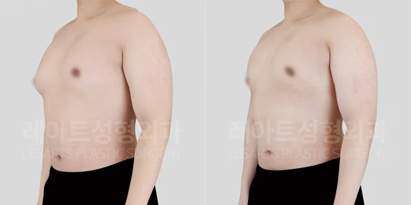 post_23_02-gynecomastia-widht-thumbnail